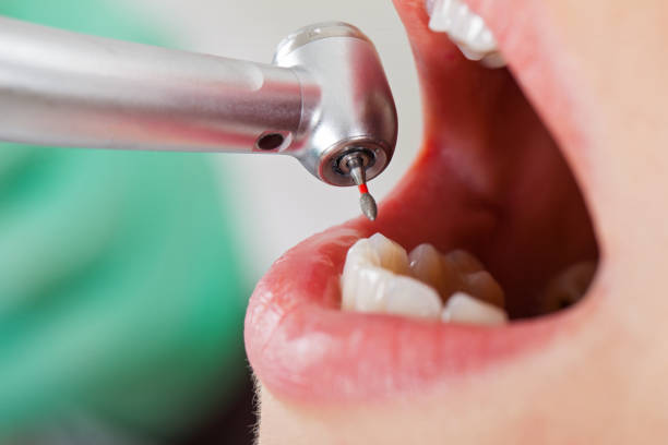Best Emergency Wisdom Teeth Removal in Wiggins, MS